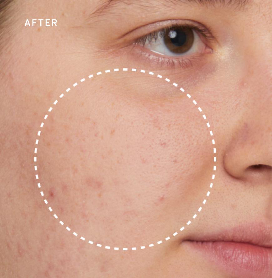 A close up on a woman’s pimples after using skin care products by Prose