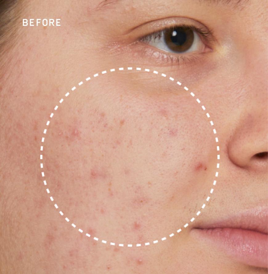 A close up on a woman’s pimples before using skin care products by Prose